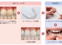 ホームホワイトニング