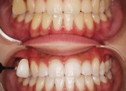 ホワイトニング症例