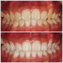 ﾎﾜｲﾄﾆﾝｸﾞ症例