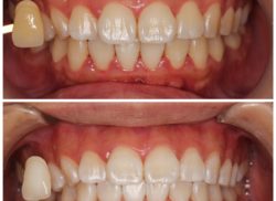 ﾎﾜｲﾄﾆﾝｸﾞ症例