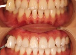 ホワイトニング症例