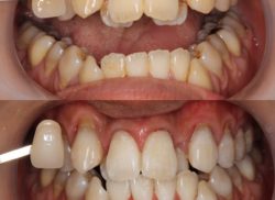 ﾎﾜｲﾄﾆﾝｸﾞ症例