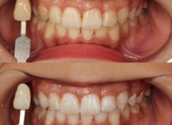 ホワイトニング症例