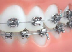 歯並びが及ぼす影響